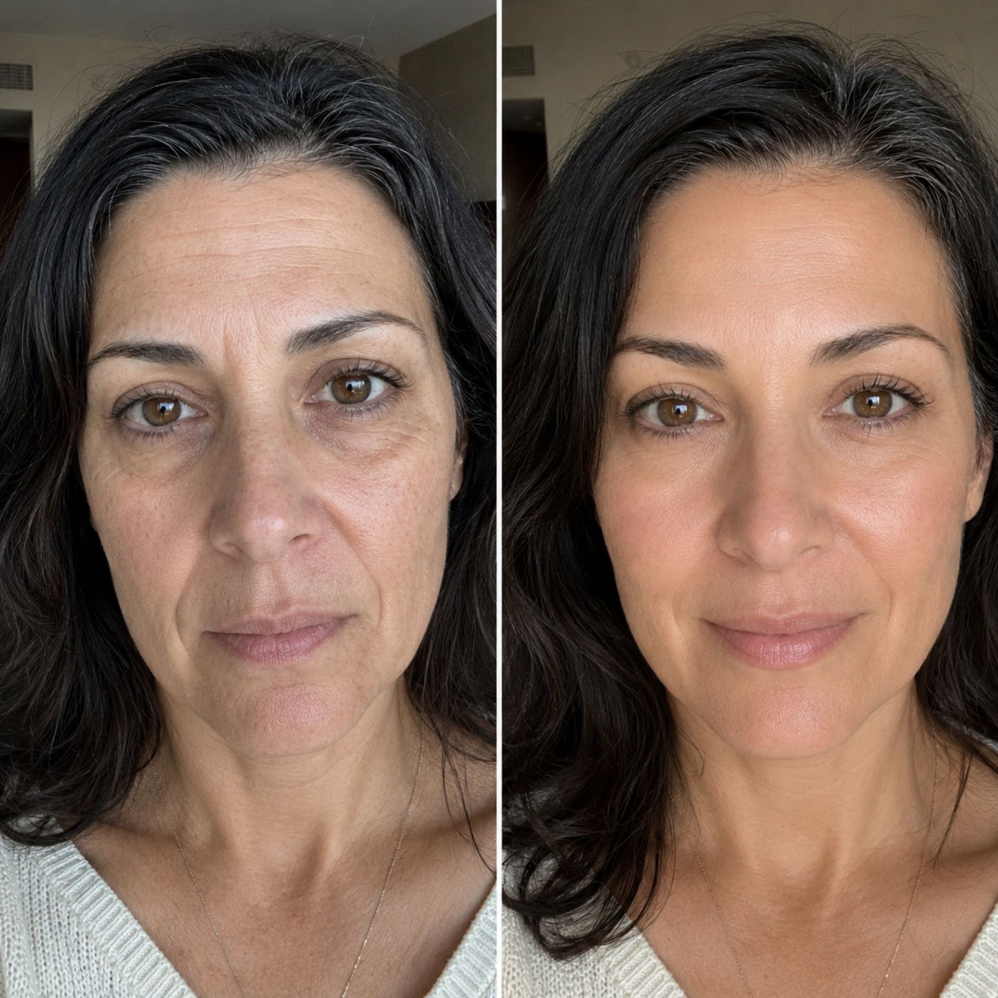100% Volufiline Ampoule